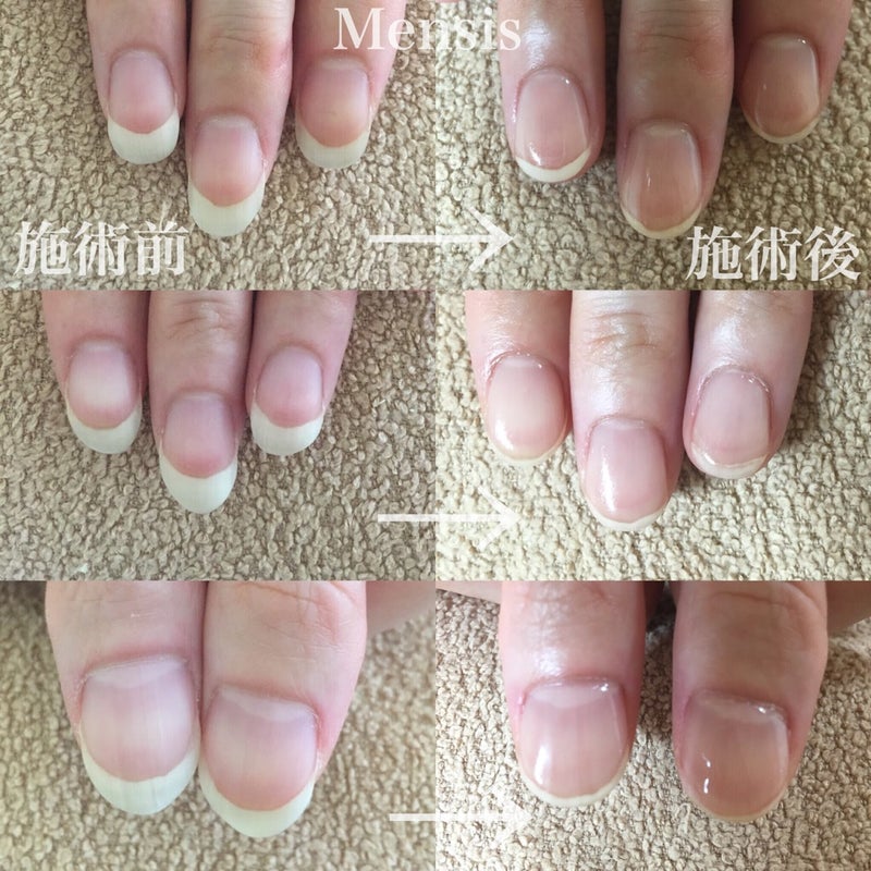 爪のピンクの部分を伸ばすなら 恵比寿メンシスネイルで 深爪矯正 727 恵比寿 爪悩み改善ネイルサロン Mensis Nail Salon