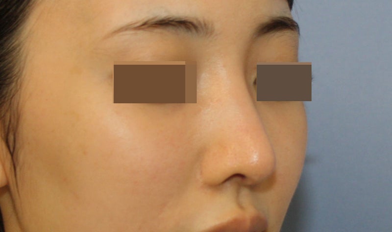 鼻中隔延長術：小鼻の張り出しと下垂が軽減　鼻尖幅が狭くなる　術後3週間