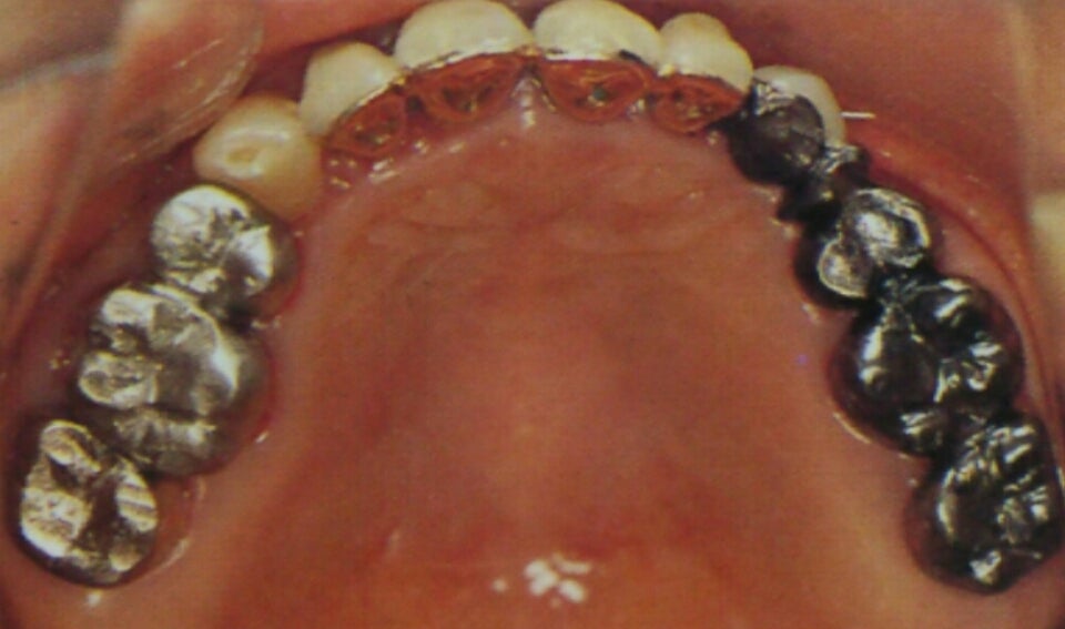 銀歯　除去冠　歯科金属　３番