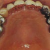 歯科金属アレルギー治療（保険適用）・・・金属歯が原因かもしれないその湿疹、かゆみの画像