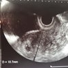 【D43】胎嚢確認からの出血からの2度目の救急外来の画像