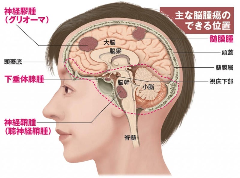 良院堂のブログ関ジャニ∞　安田章大さんが患った　脳腫瘍の一種【髄膜腫】とは
