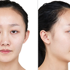 [韓国美容整形]ブラウン美容外科・中国女性のBEFORE&AFTER❷の記事より