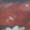 口の中に見られる「梅毒」の症状について ・・・最後は死に至る可能性のある恐ろしい性感染症の画像
