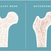柳千妃路のホメオパシー相談会で「骨粗鬆症」をどう対処するかをご紹介しますの画像
