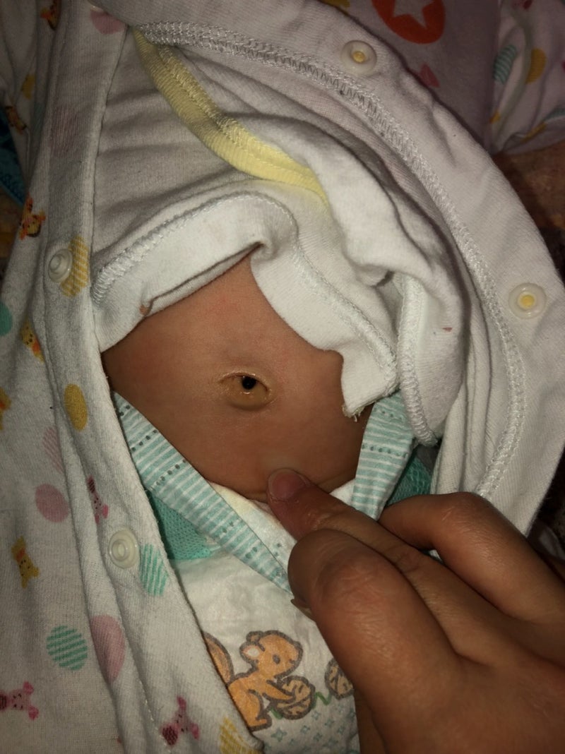 赤ちゃんの臍肉芽腫（さいにくげしゅ）？ 桜葵のブログ