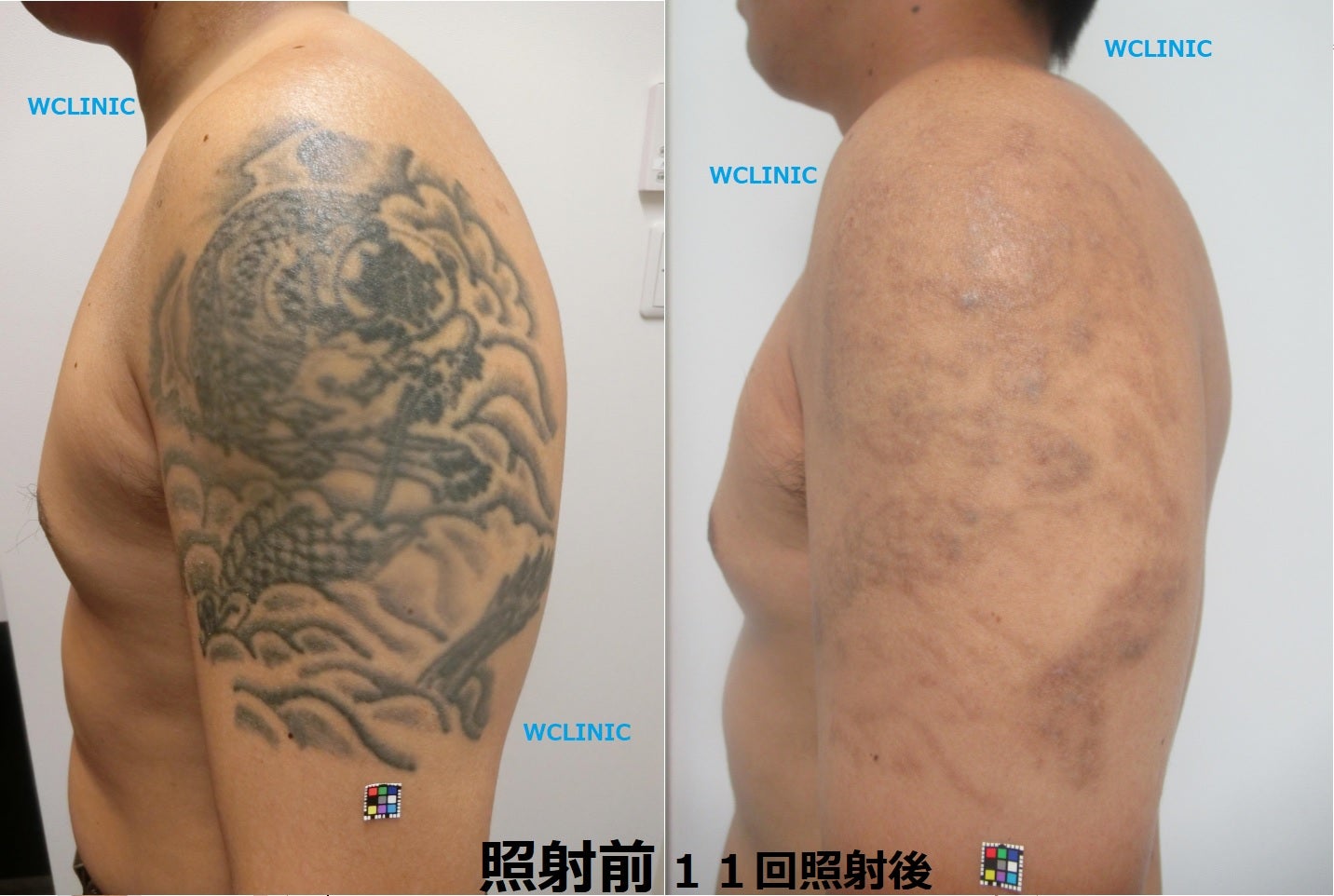 タトゥー除去・刺青除去（二の腕）～大阪・心斎橋・Wクリニック～ Wクリニック タトゥー・刺青除去のブログ