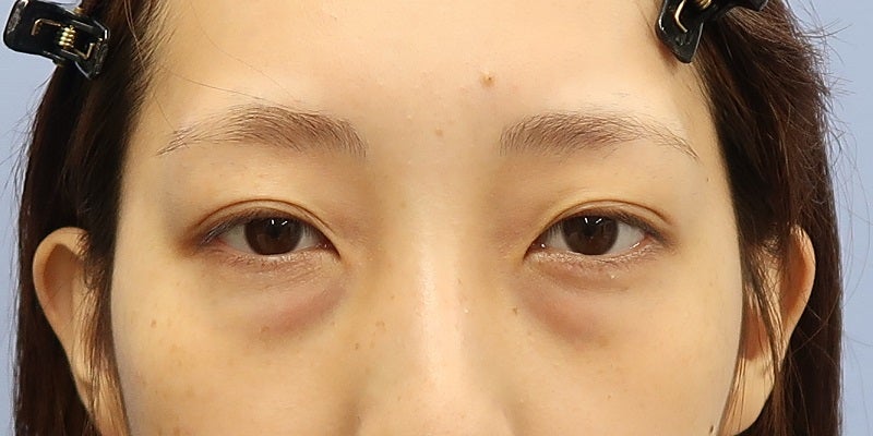 目の下のクマ改善手術 施術後1か月一例 Classy 仙台美容外科 美容皮膚科 ブログ