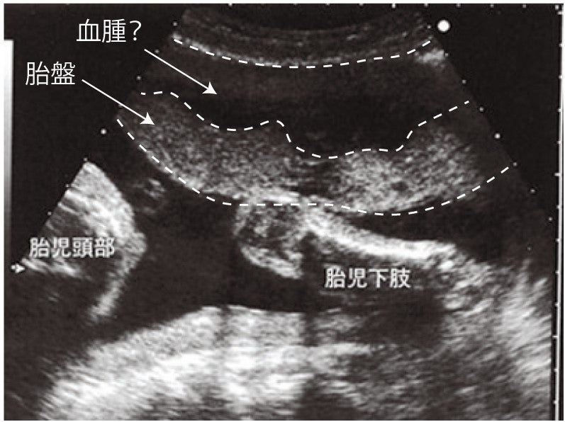 位 胎盤 早期 剥離 常
