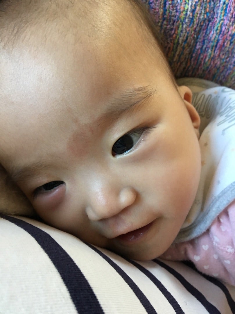赤ちゃんの目の腫れ ももあい母のブログ