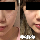 [症例写真集]id美容外科の両顎専門医！ヒョン・ウォンソク先生の症例写真☆彡の記事より