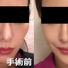[症例写真集]id美容外科の両顎専門医！ヒョン・ウォンソク先生の症例写真☆彡の記事より