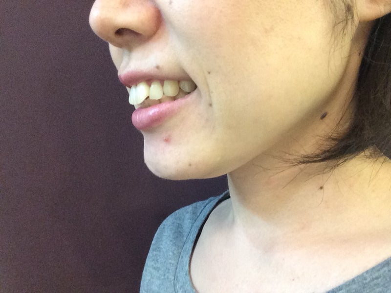 歯列矯正したら美しくない顔になった話 女32歳startサリの歯列矯正ブログ