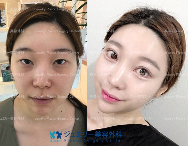 ジュエリー美容外科ー二重 切開 目つき矯正 目頭目尻目尻下げ 脂肪再配置 顔 脂肪移植 韓国整形ジュエリー美容外科のスタッフ ちえのブログ