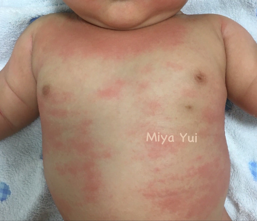 環境保護主義者 スクリーチ 写真 赤ちゃん お腹 背中 赤い 湿疹 jg8mta.jp