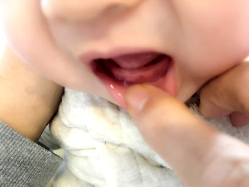 赤ちゃん 歯茎 白い