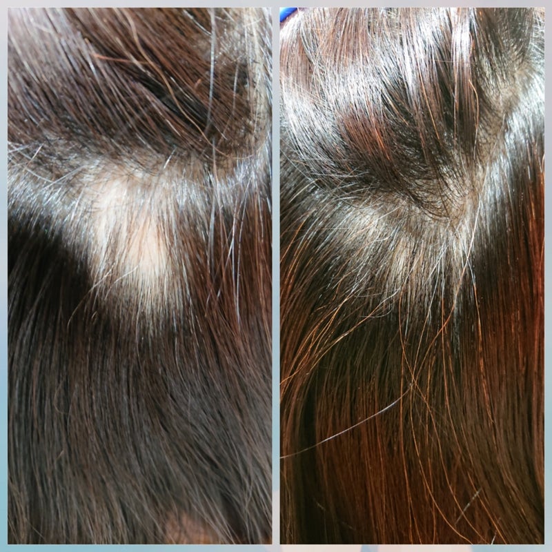 回復 症 期 脱毛 円形 円形脱毛症の回復期にはどんな兆候が見られるの？