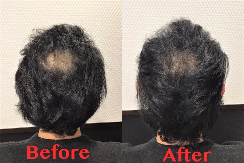 頭頂部の薄毛に悩ませれている３０代男性の髪形のご紹介 植毛美容師