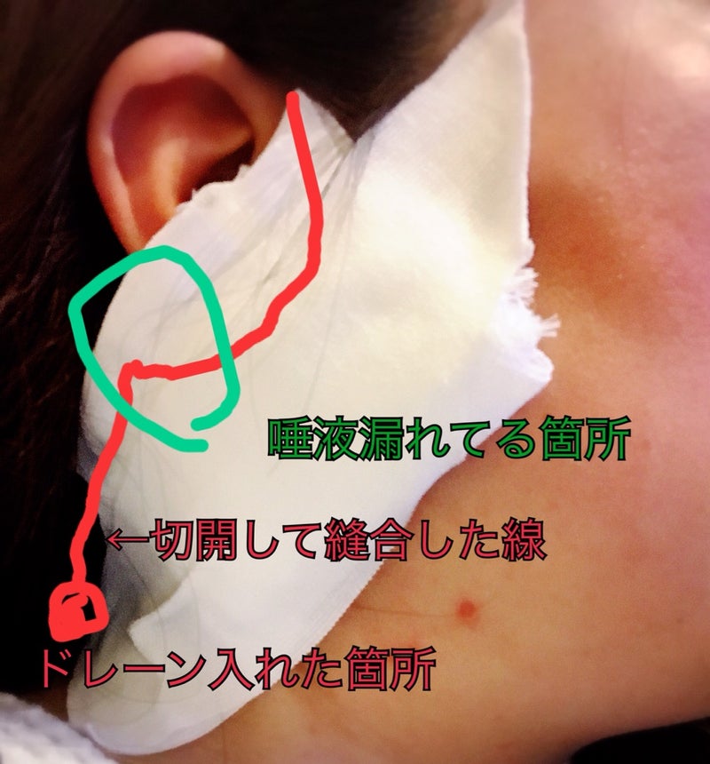耳 下 腺 腫瘍