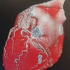 狭心症…心臓のＣＴ画像の画像