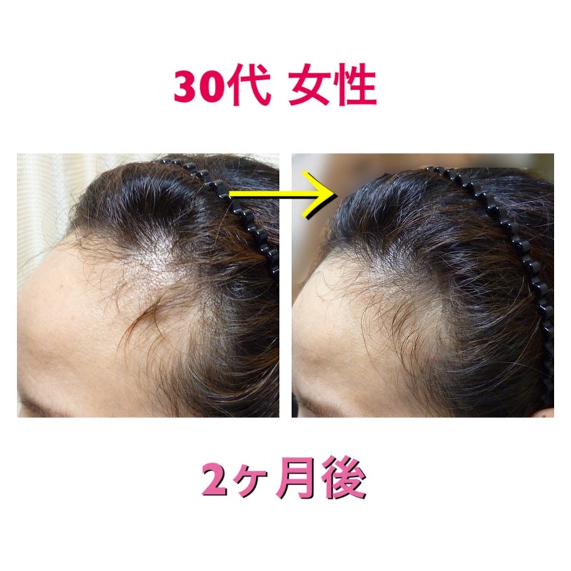 2ヶ月で生え際が変化 名古屋栄で発毛育毛 頭皮ケア 薄毛抜け毛aga治療に本格的発毛サロン 男性女性の薄毛抜け毛の悩みを解消します