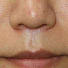 小鼻が広がらない人中短縮術（鼻下短縮・リップリフト）の記事より