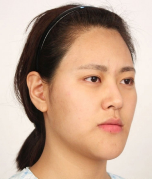 しゃくれ顎からさわやかなラブリーガールに変身された女性の体験談 フェイスライン整形外科 韓国整形無料サポートナビコリア 韓国 整形エージェント 韓国整形ブログ