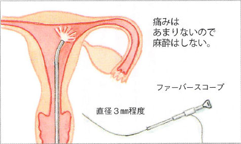 不妊症の一般的な検査 子宮鏡検査 カメラで子宮 卵管の状態を調べます 英ウィメンズクリニック 不妊治療の専門クリニック