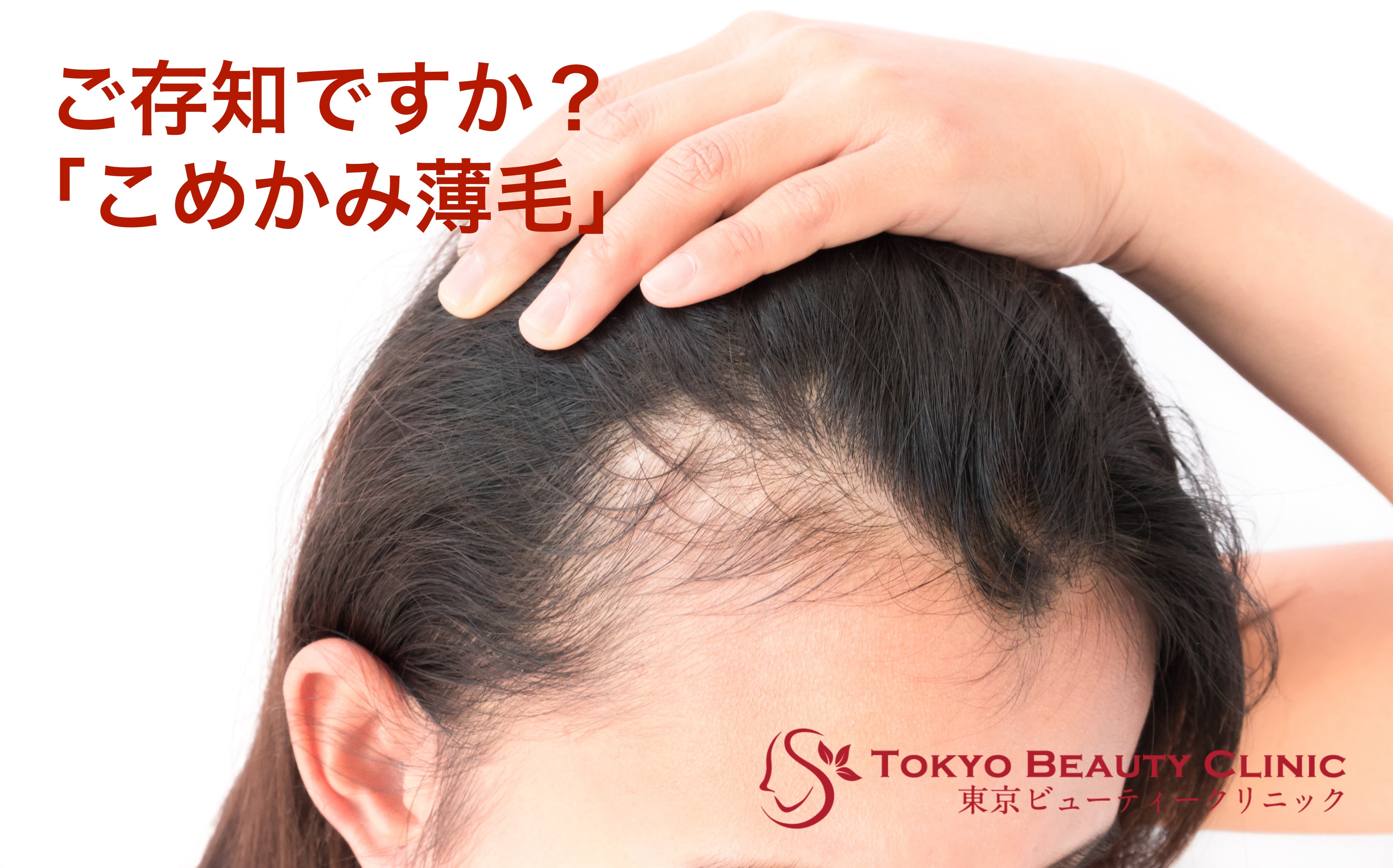 こめかみ薄毛ってご存知ですか 女性の発毛専門クリニック東京