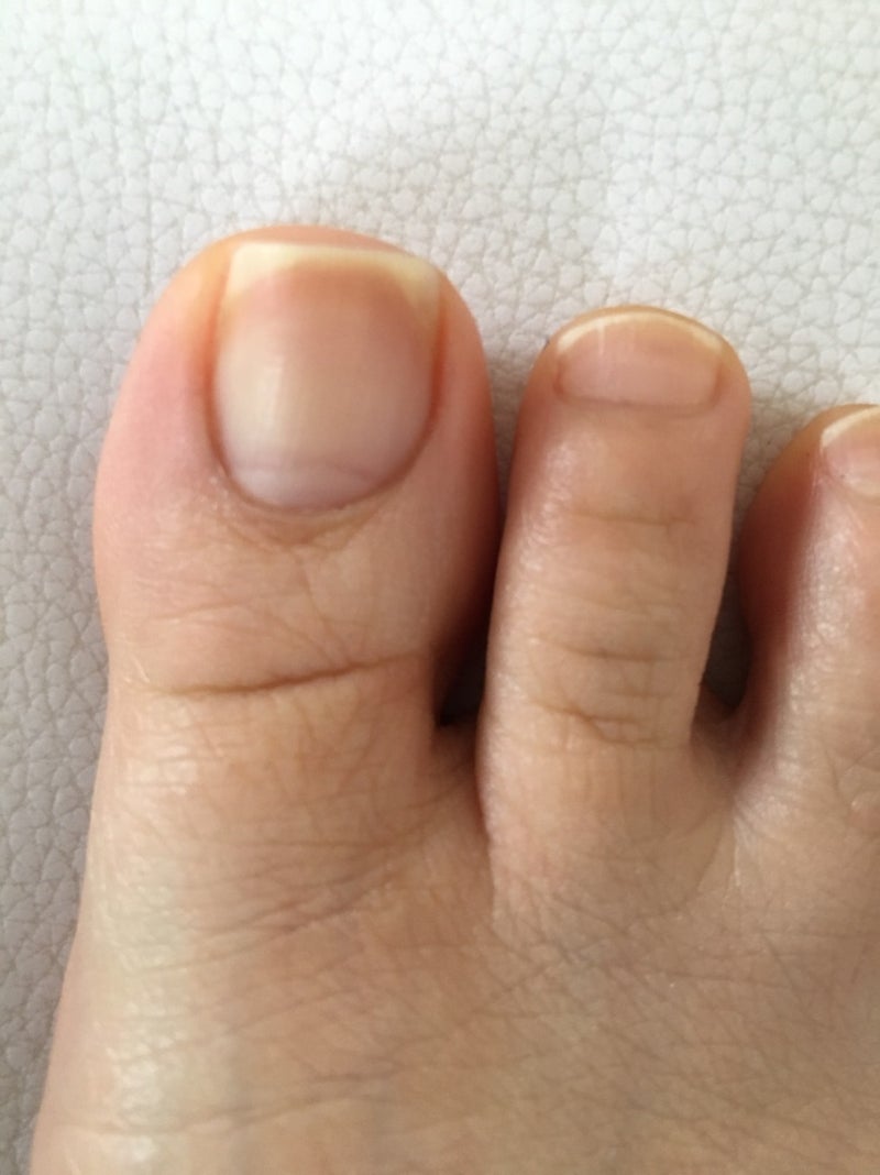 足の爪の切り方 | 釧路の巻き爪とフットケア専門店 miki のブログ