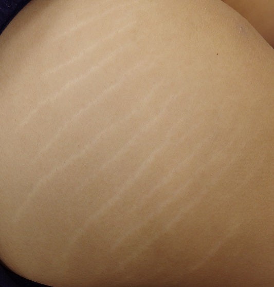 肉割れ・妊娠線】治療でどれくらいよくなるの？ | Drこじまの美容皮膚