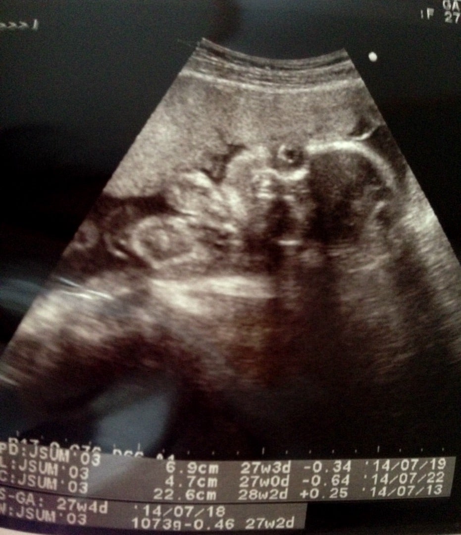 エコー 見方 写真 初期 妊娠