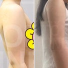 【韓国美容整形】≪tuy様≫ ビョン先生が手掛けられた韓国の患者様 "tuy様" 二の腕2ヶ月後の記事より