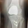 膝のレントゲン写真の画像