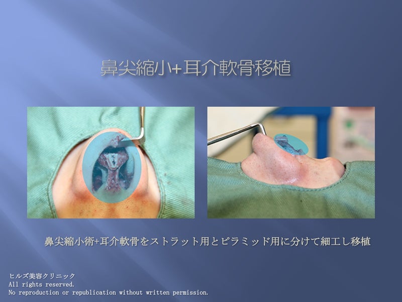 鼻尖縮小+耳介軟骨移植 手術中の写真