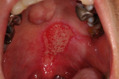 口腔内の熱傷（やけど） | toshiのブログ