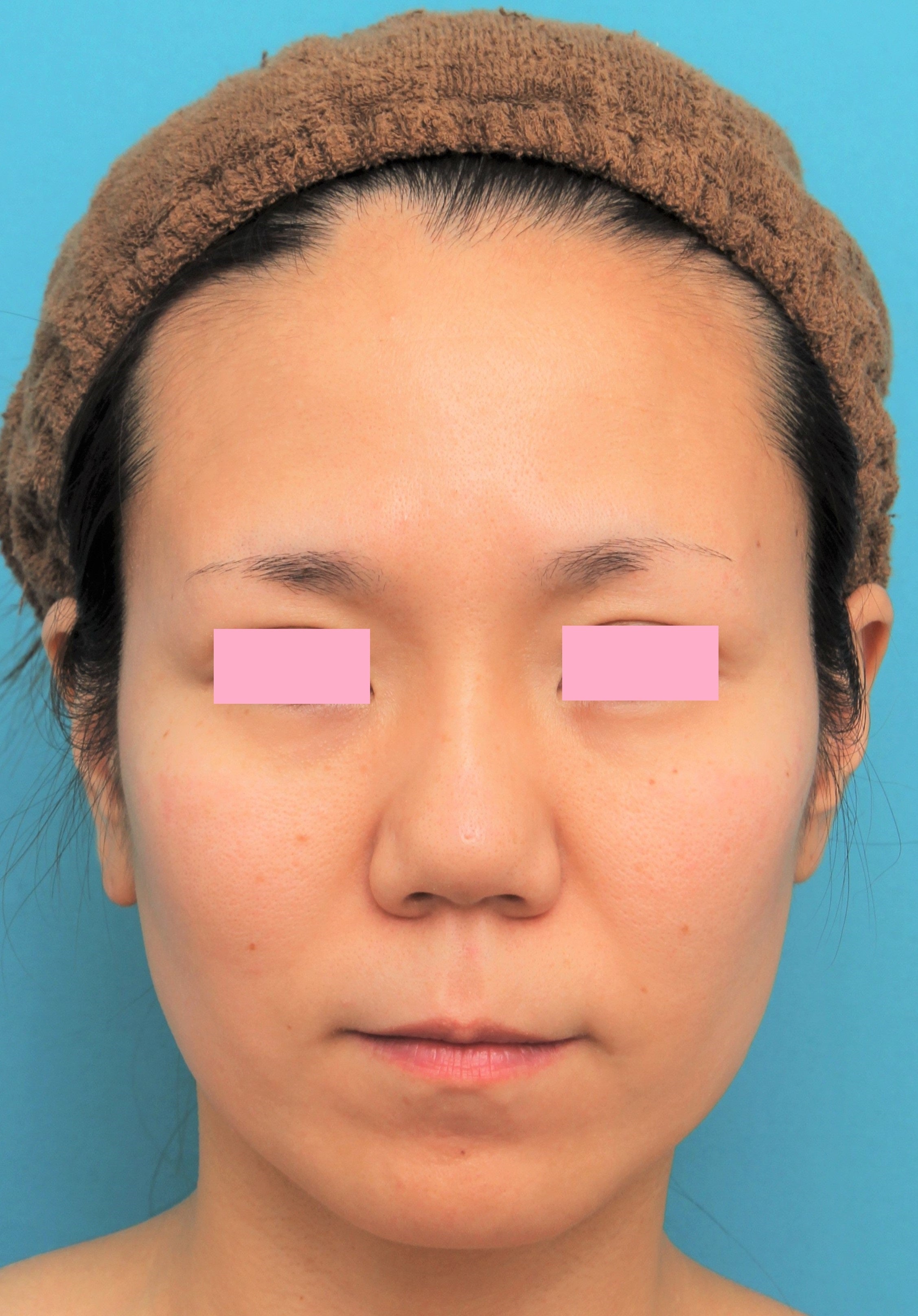 バッカルファット除去手術を行った30代女性の症例写真の解説です。 美容整形高須クリニック 高須 幹弥 オフィシャルブログ
