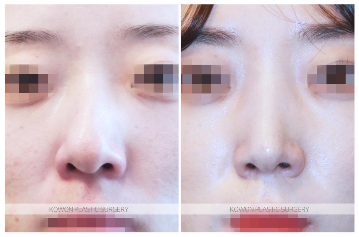 症例紹介 曲がった鼻の手術 韓国の鼻手術専門 コウォン整形外科