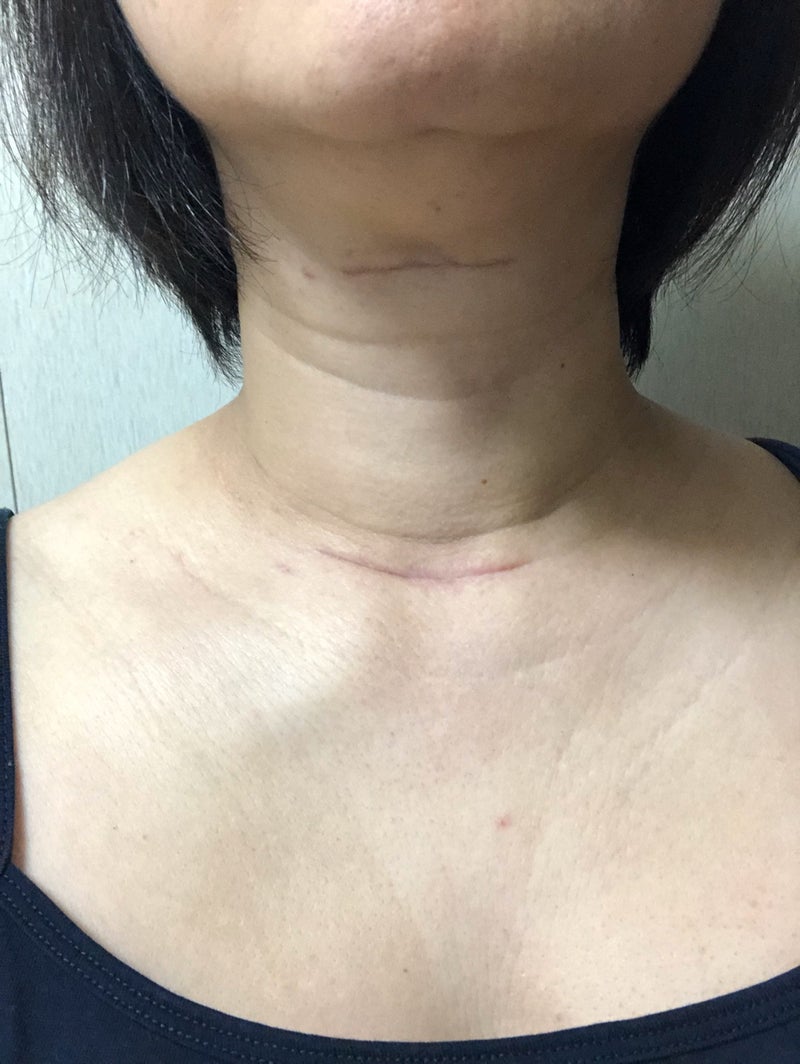 甲状腺の手術から3ヶ月が経った傷跡 甲状腺がんと乳がんが同時多発テロ なアラフィフ女の生活日記