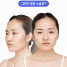 ［韓国美容整形］ブラウン整形外科の輪郭手術で美女誕生REAL STORY♡の記事より