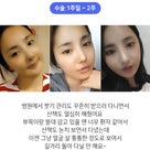 ［韓国美容整形］ブラウン整形外科の輪郭手術で美女誕生REAL STORY♡の記事より