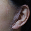フェイスリフト美容整形外科手術・耳の後ろの傷のテープが臭くなってきた～っの画像