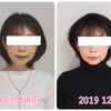 【京都市・中京区からご来店】小顔矯正をしてから顎関節が改善してきました♪50代女性の画像