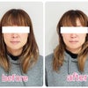 【京都市・伏見区からご来店】フェイスラインがここまで変わる！チャーミングな30代女性の画像