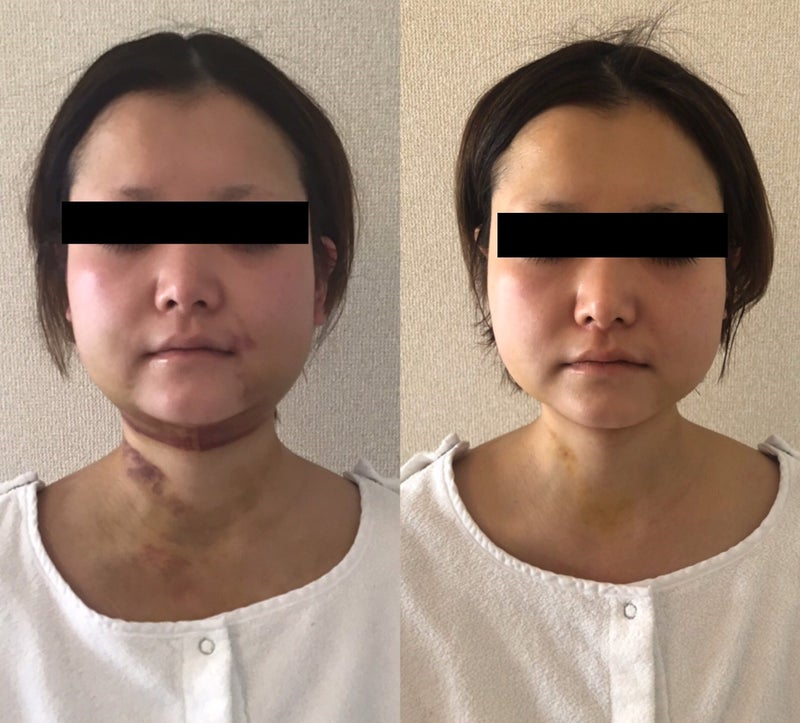 顔の脂肪吸引後のダウンタイムにindibaを用いた経過 Medical Indiba Salon Kmk 脂肪吸引後ダウンタイムマザーのブログ