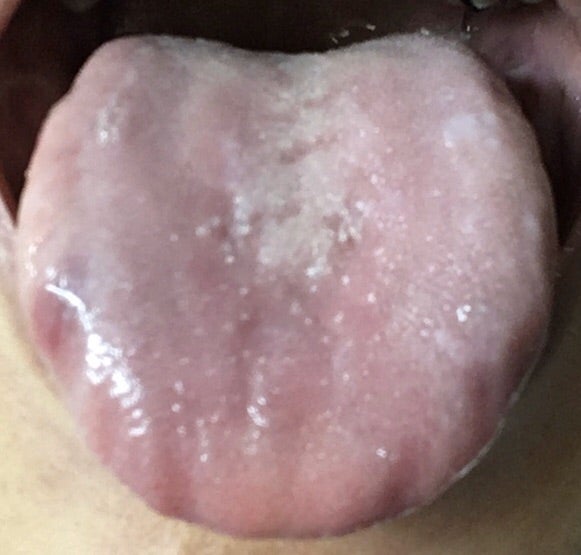 診 写真 舌 舌診