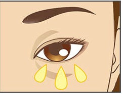 下眼瞼の脂肪除去の症例解説（目の下のくま）