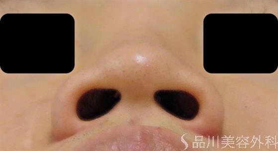 小鼻を切開する難しさ 品川美容外科 渋谷院 院長 和田哲行のブログ