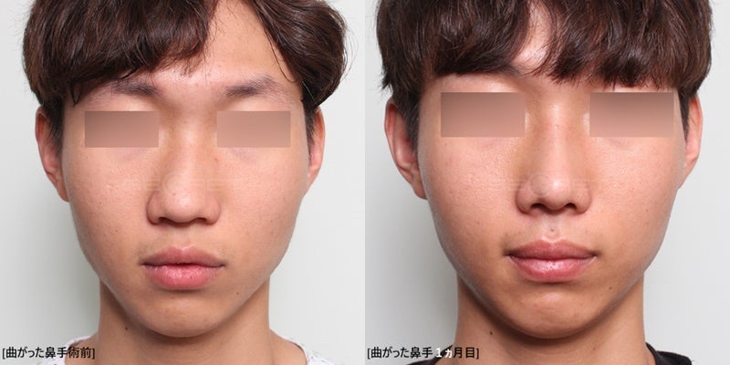 韓国整形外科シークレット 術後写真 男子曲がり鼻 １ヵ月目 韓国シークレット整形外科