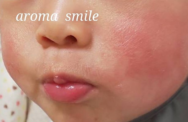 よだれかぶれ 食物アレルギー 口の周りの湿疹の原因はもしかしたら 東京都 江戸川区 乳児湿疹 小児アトピーを６か月で根本改善